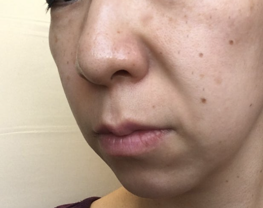 たるみが原因でできる「大人ニキビ」とは!